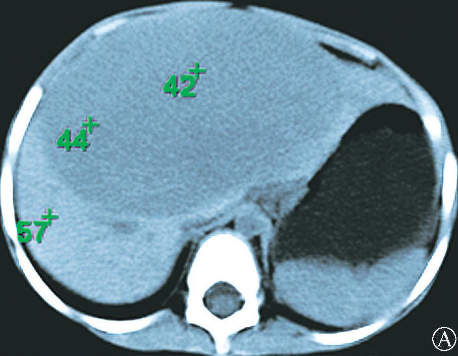 第八节 肝间叶性错构瘤